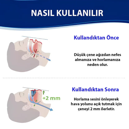 Ayarlanabilir Anti-Horlama Ağızlığı
